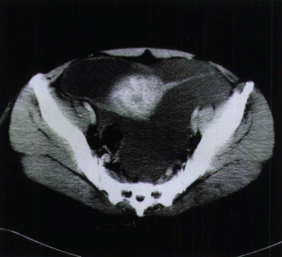 卵巢畸胎瘤(病例2～3)